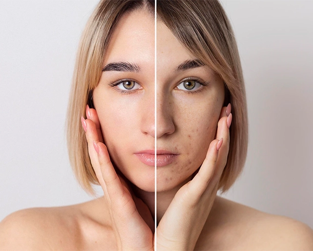 Dermapen Nedir?