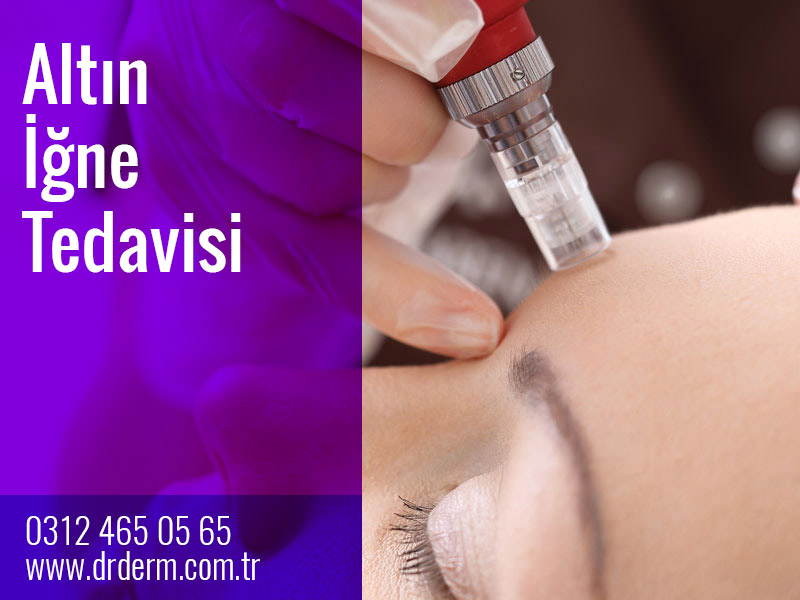 Altın İğne Tedavisi Bodrum