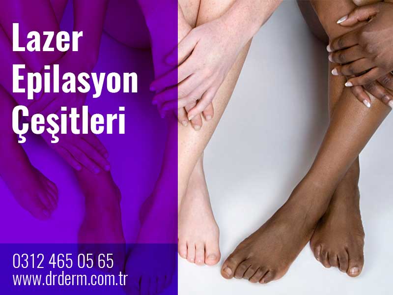 Lazer Epilasyon Çeşitleri