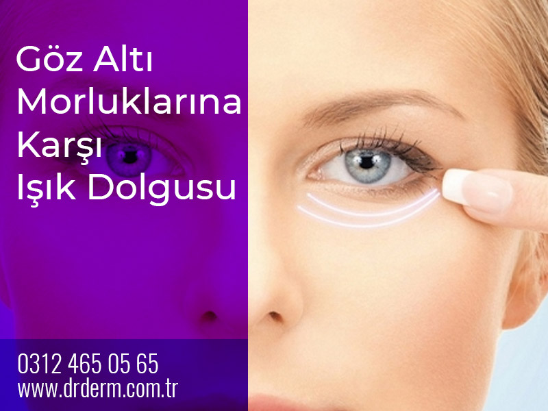Göz Altı Morluklarına Karşı Işık Dolgusu