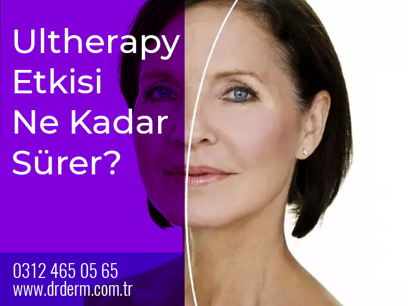 Ultherapy Etkisi Ne Kadar Sürer?