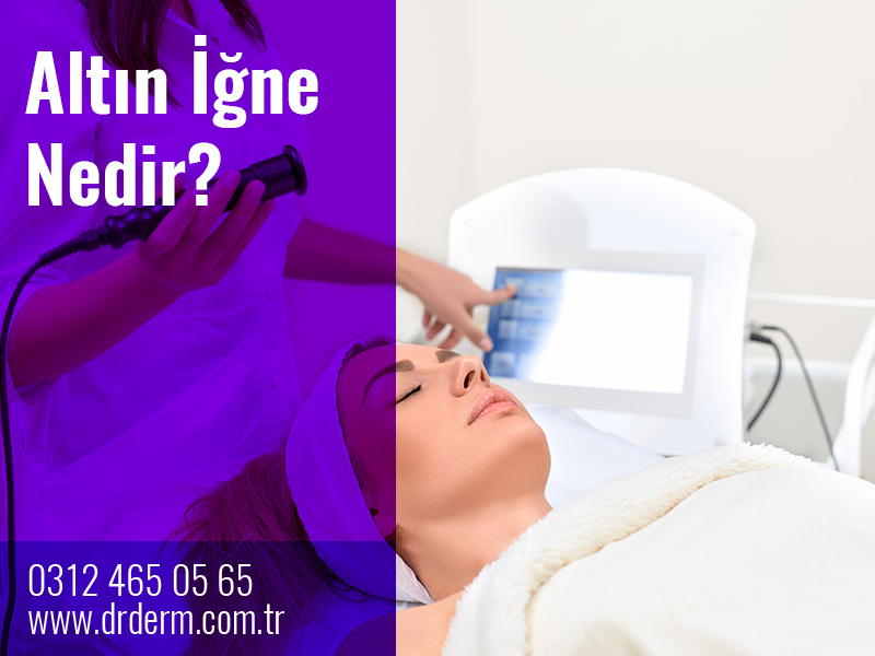 Altın İğne Nedir?