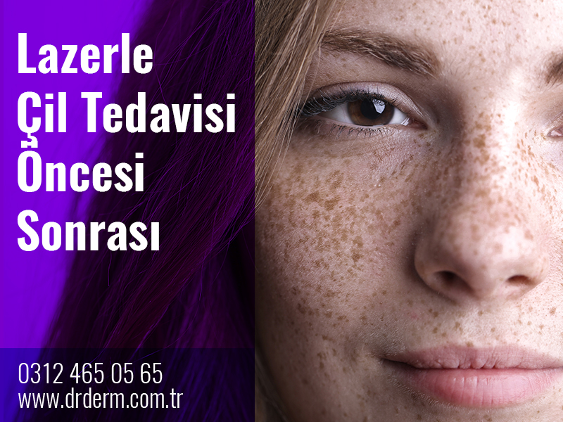 Lazerle Çil Tedavisi Öncesi Sonrası