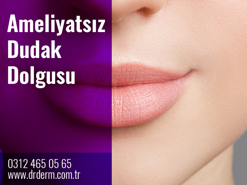 Ameliyatsız Dudak Dolgusu