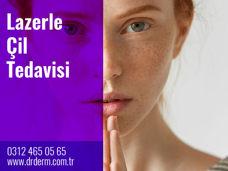 Lazerle Çil Tedavisi Nedir?